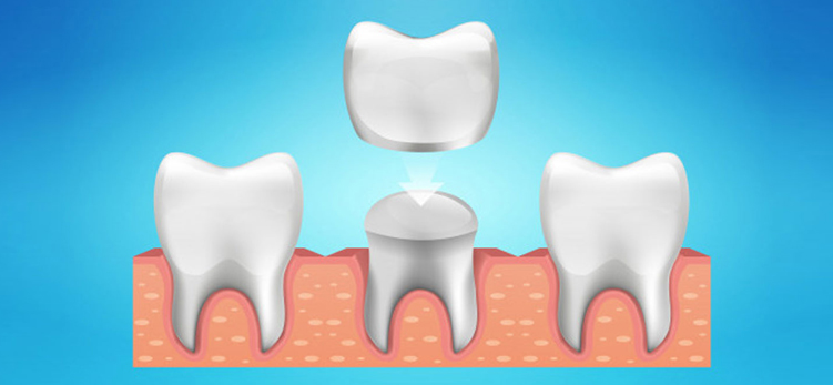 dental-crown--Dhee- Dentist-triplicane-Chennai