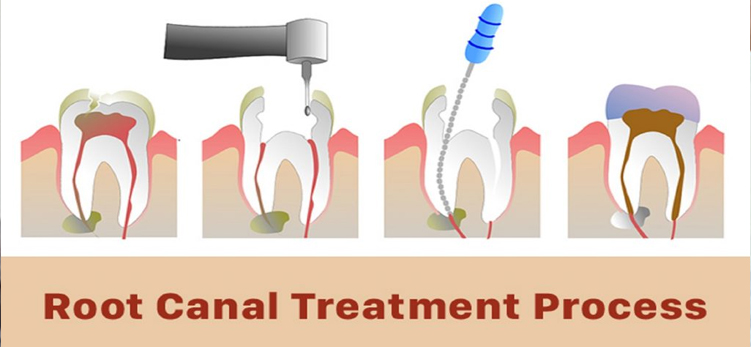 Root canal treatment chennai