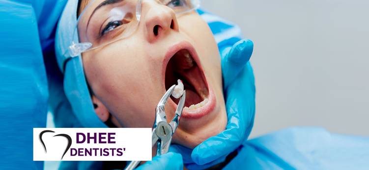 Root Canal treatment in Chennai