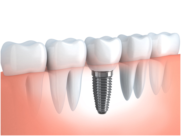 Dental Implants Treatment in Triplicane